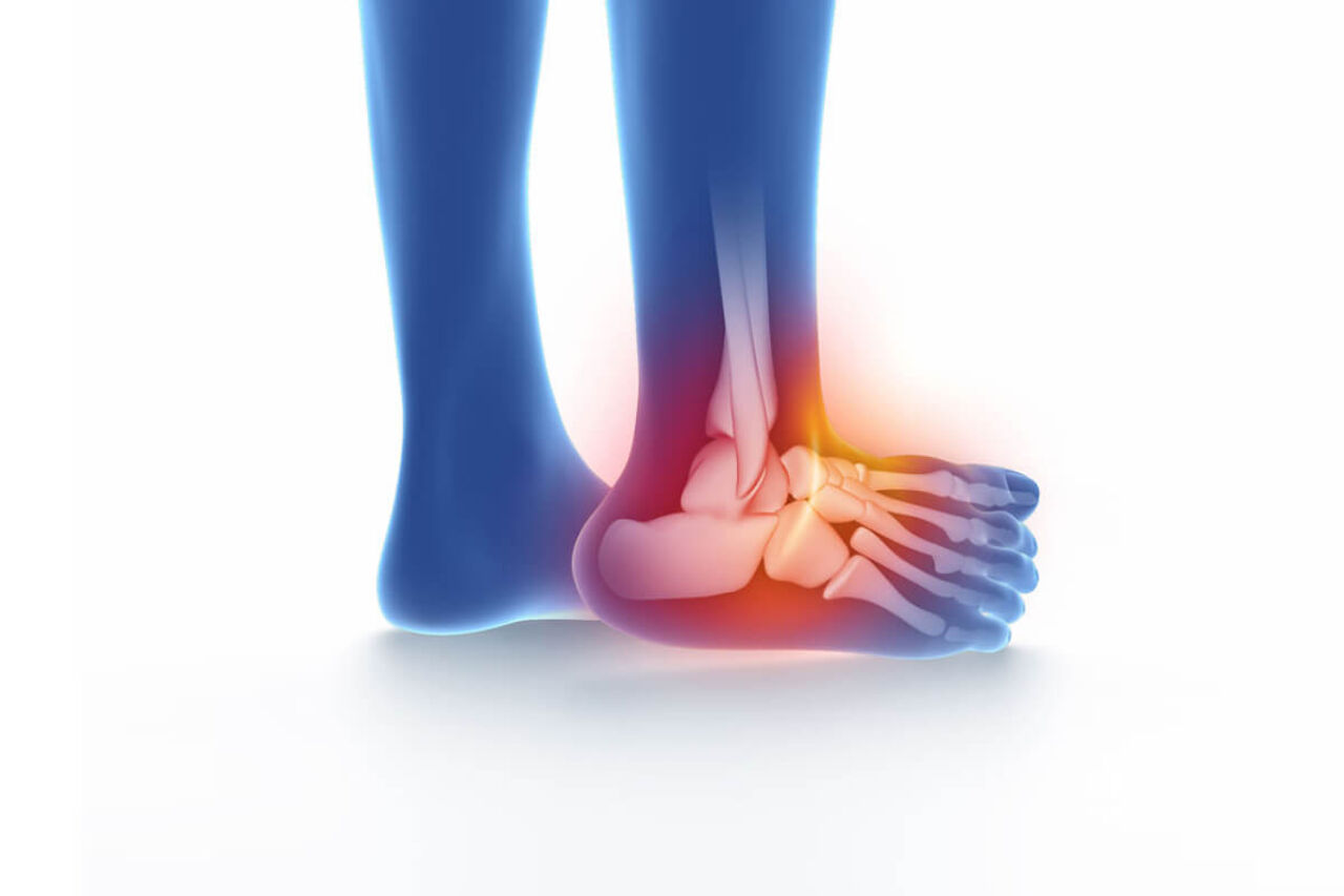 je me suis fait un bonne entorse